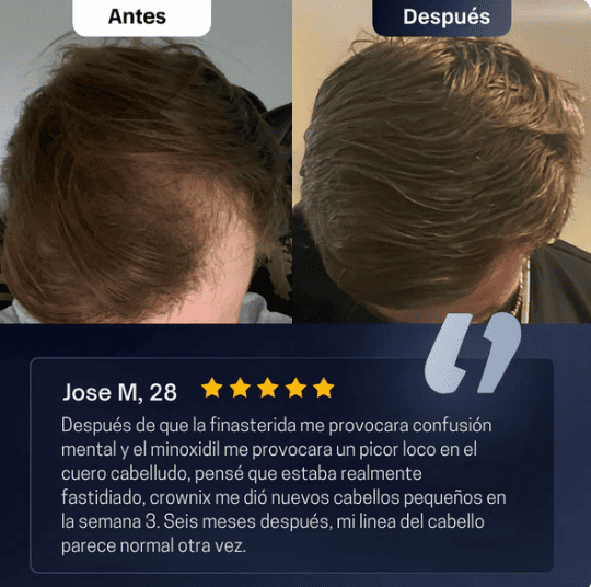 Frena la caída del cabello antes de que sea irreversible, en tan solo unas semanas